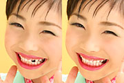 歯修正イメージ